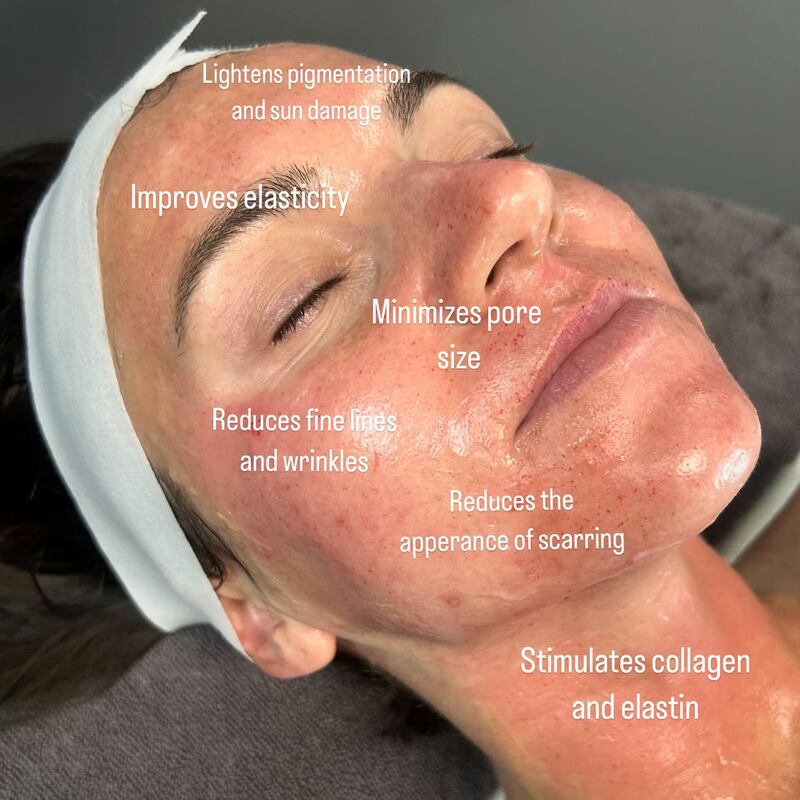 microneedling
