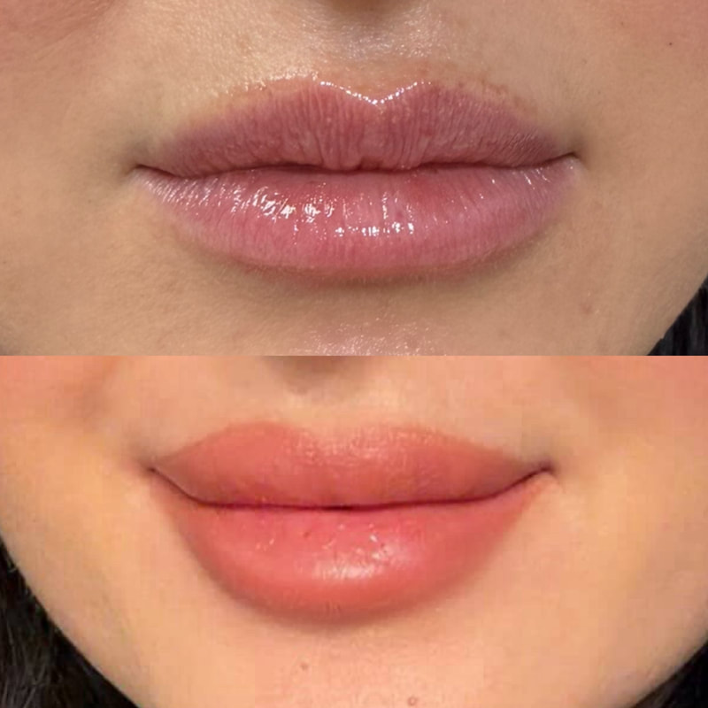 Botox before wrinkles Pleasant View UT