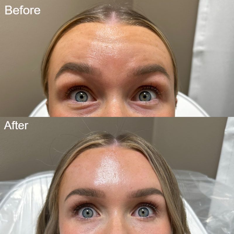 neurotoxin patient after