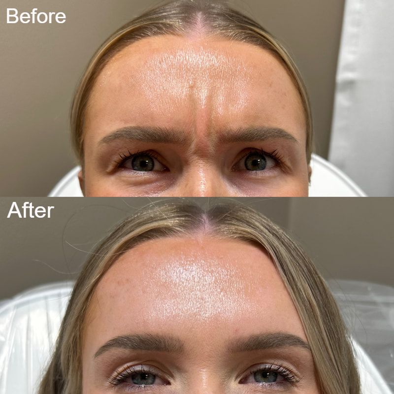 neurotoxin patient result