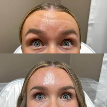 Hyde Beauty and Wellness Spa for Botox