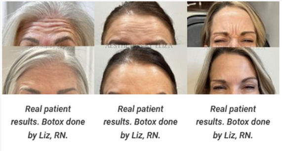 botox treatment in pleasant view