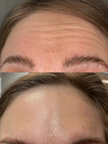 horizontal forehead line treatment North Ogden UT