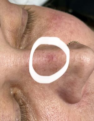 laser vascular reduction