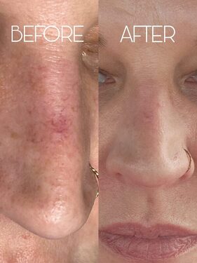 vascular reduction result