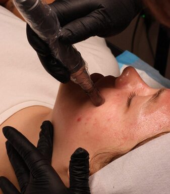 microneedling treatment