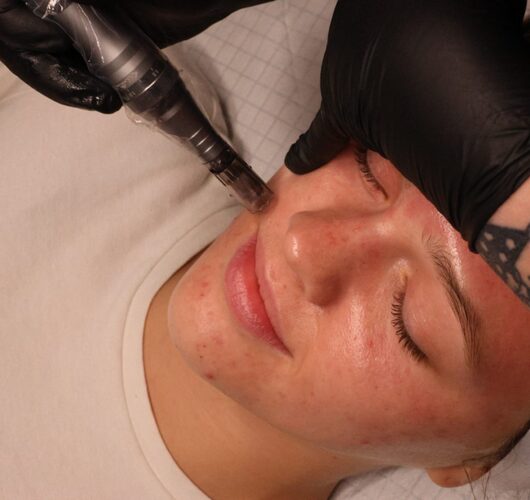 facial microneedling
