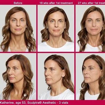 sculptra treatment