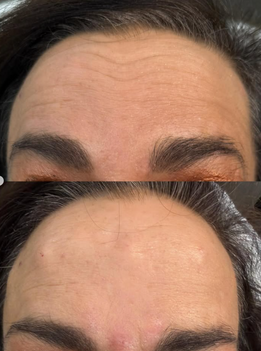 Botox for forehead lines near North Ogden Utah