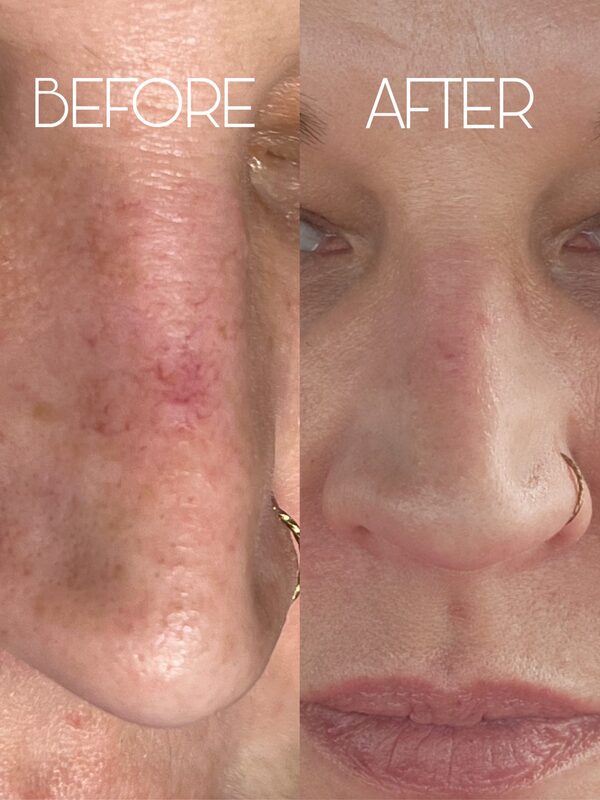 vascular reduction before and after