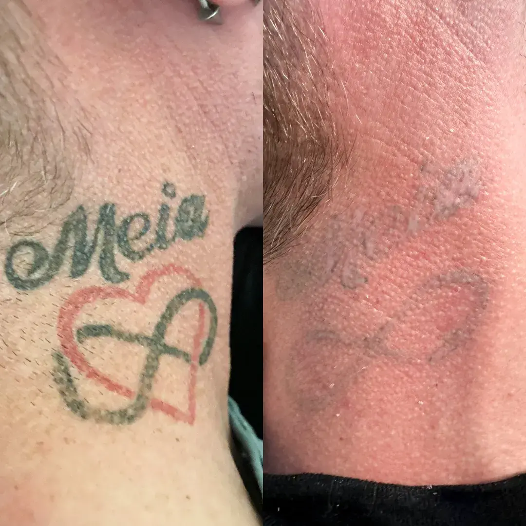 laser tattoo removal