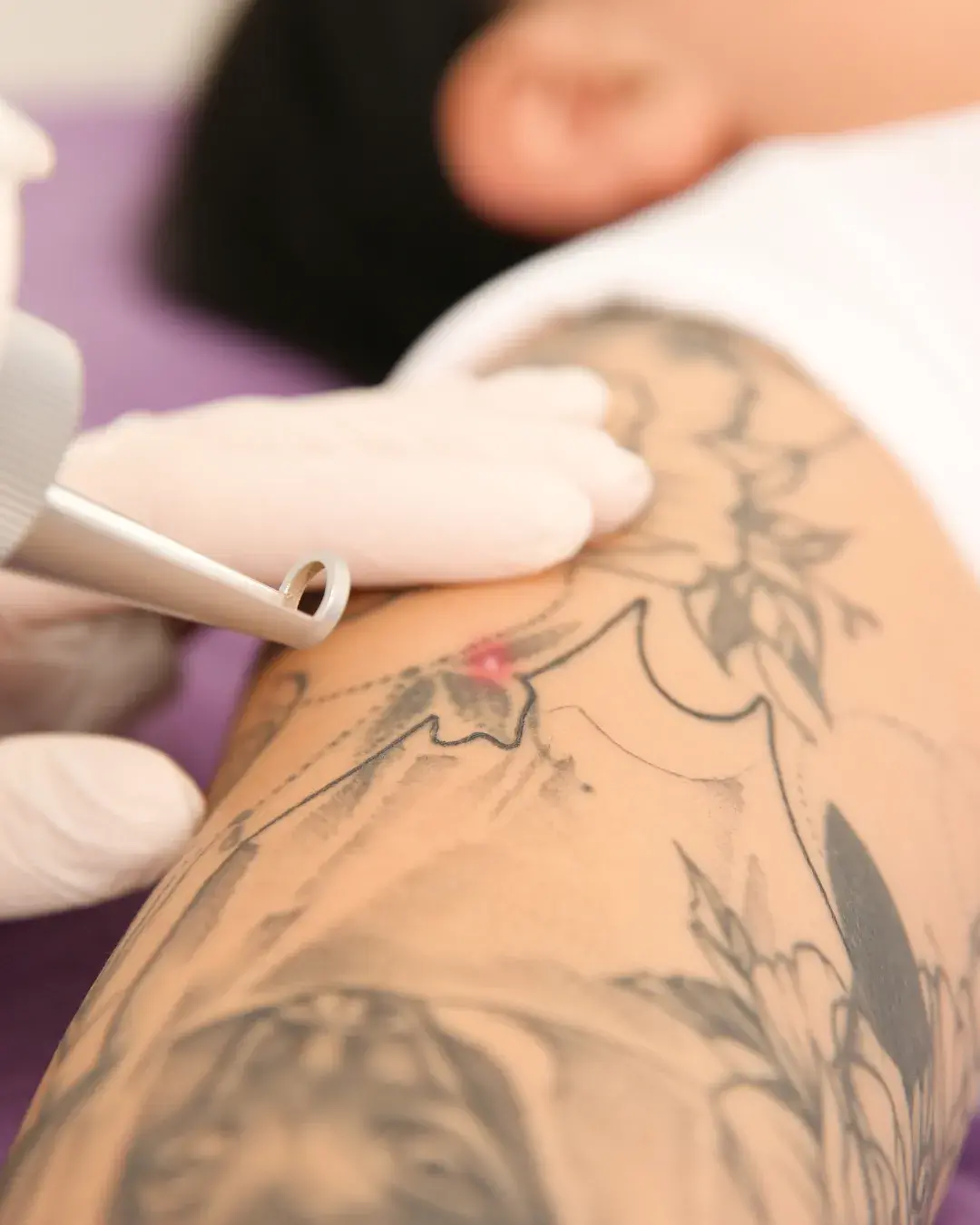 tattoo removal
