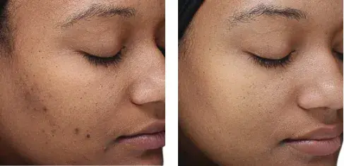 VI Peel Treatment