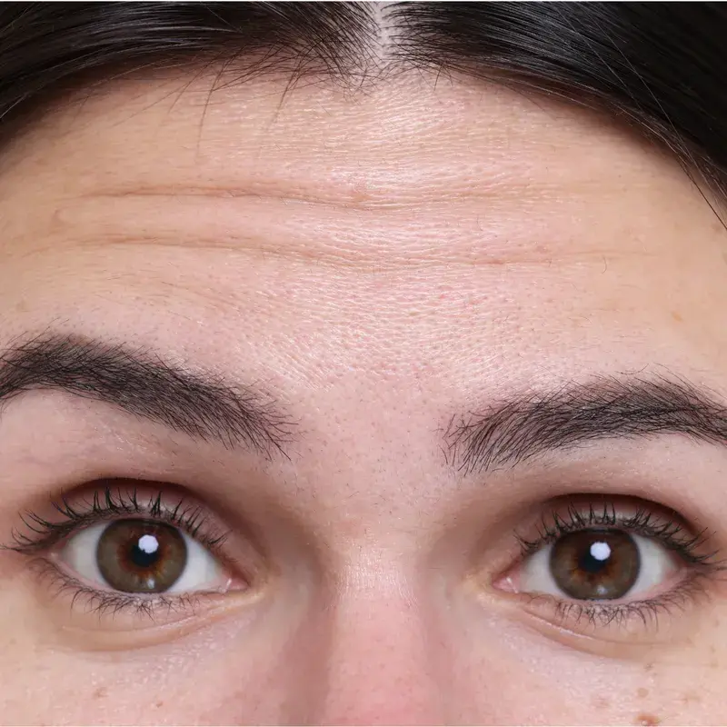 wrinkle reduction