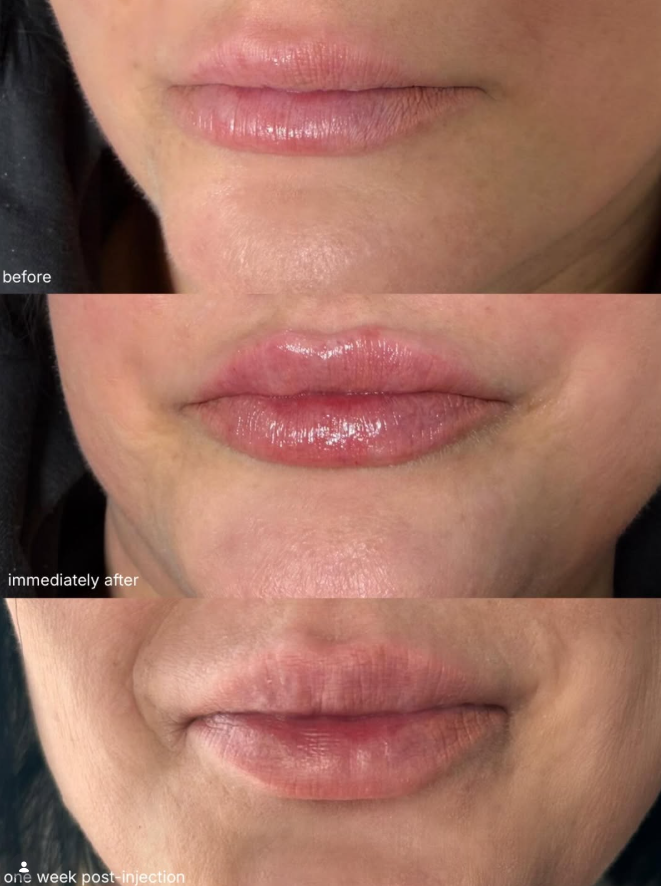 Looking for Natural Lip Filler in Pleasant View UT