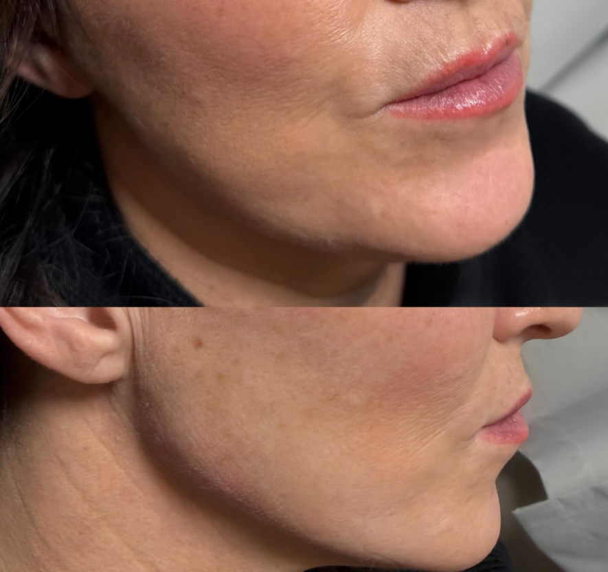Natural Lip Filler in Pleasant View UT for Soft Youthful Volume