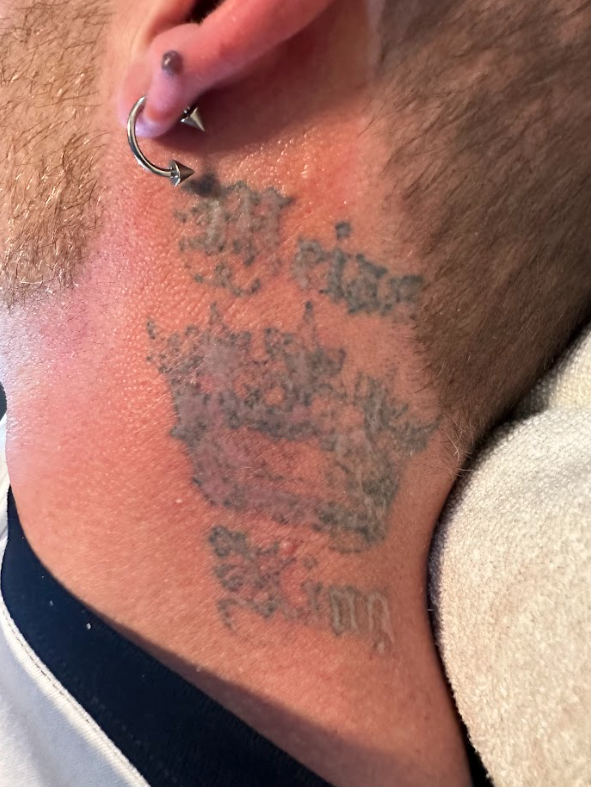 laser tattoo removal Pleasant View UT