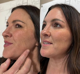 Anti-aging peptide therapy treatment