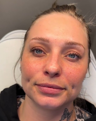 Botox vs Filler