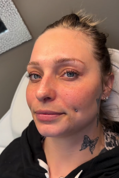 Botox for crow’s feet Pleasant View Utah