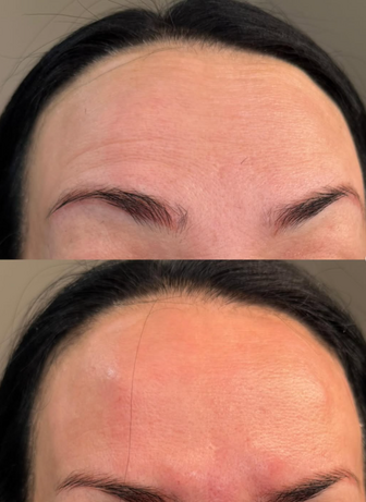 forehead Botox Pleasant View UT