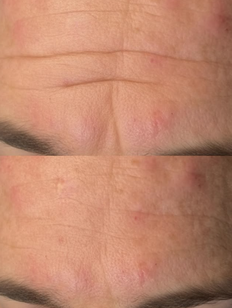 smooth forehead Botox Pleasant View