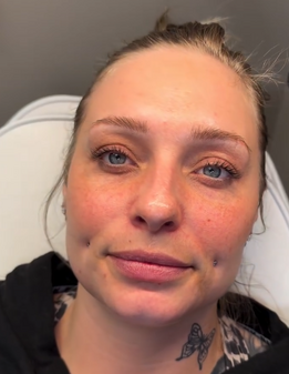 crow’s feet wrinkle reduction Pleasant View