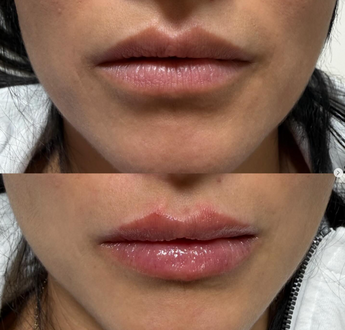 Personalized Natural Lip Filler in Pleasant View UT