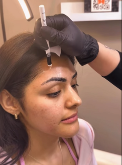preventative Botox age North Ogden Utah