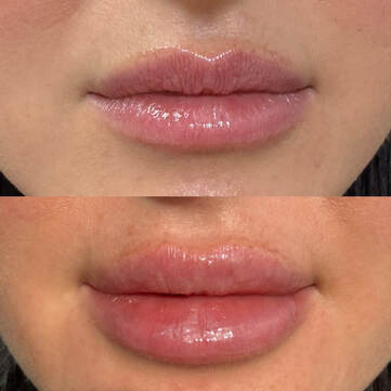 TMJ Botox Pleasant View UT