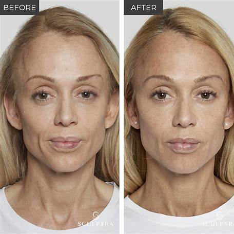 sculptra injections