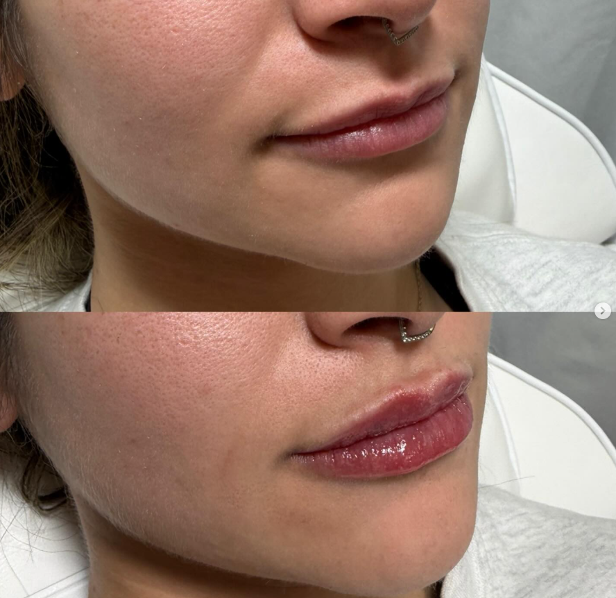 Subtle Natural Lip Filler in Pleasant View UT