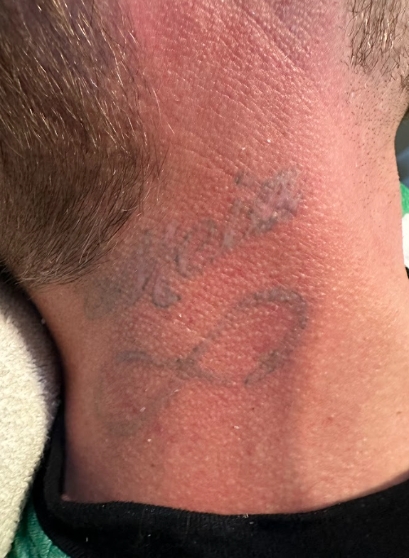 tattoo fading for cover up Pleasant View