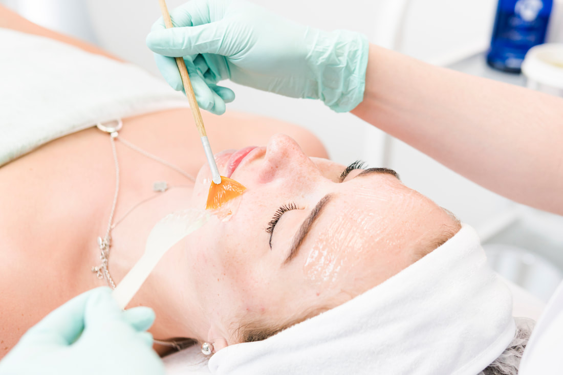 Chemical Peels